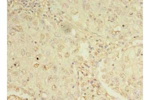 Immunohistochemistry of paraffin-embedded human lung cancer using ABIN7162276 at dilution of 1:100 (ORMDL1 抗体  (AA 48-100))