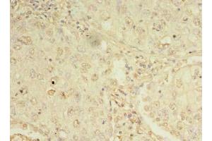 Immunohistochemistry of paraffin-embedded human lung cancer using ABIN7162276 at dilution of 1:100