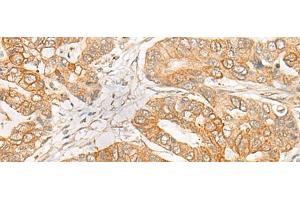 Immunohistochemistry of paraffin-embedded Human gastric cancer tissue using GNB1L Polyclonal Antibody at dilution of 1:35(x200) (GNB1L 抗体)
