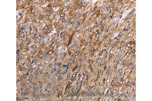 Immunohistochemistry of Human esophagus cancer using GRPR Polyclonal Antibody at dilution of 1:40 (GRPR 抗体)