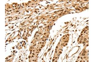 The image on the left is immunohistochemistry of paraffin-embedded Human esophagus cancer tissue using ABIN7192627(SPATA20 Antibody) at dilution 1/70, on the right is treated with synthetic peptide. (SPATA2 抗体)