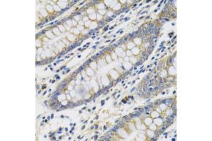Immunohistochemistry of paraffin-embedded human colon using PGF Antibody (ABIN5970864) at dilution of 1/100 (40x lens). (PLGF 抗体)