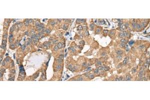 Immunohistochemistry of paraffin-embedded Human thyroid cancer tissue using BCHE Polyclonal Antibody at dilution of 1:40(x200) (Butyrylcholinesterase 抗体)