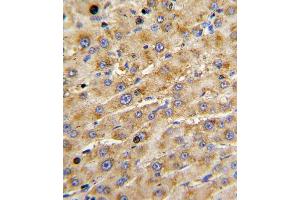 Formalin-fixed and paraffin-embedded human hepatocarcinoma with ADAMTS13 Antibody , which was peroxidase-conjugated to the secondary antibody, followed by DAB staining.