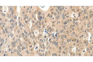 Immunohistochemistry of paraffin-embedded Human ovarian cancer tissue using ROS1 Polyclonal Antibody at dilution 1:40 (ROS1 抗体)