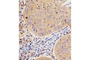 B staining GCLM in human cervical carcinoma tissue sections by Immunohistochemistry (IHC-P - paraformaldehyde-fixed, paraffin-embedded sections). (GCLM 抗体  (C-Term))