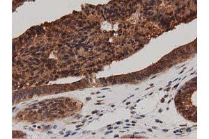 Immunohistochemical staining of paraffin-embedded Adenocarcinoma of Human ovary tissue using anti-DNAJA2 mouse monoclonal antibody. (DNAJA2 抗体)