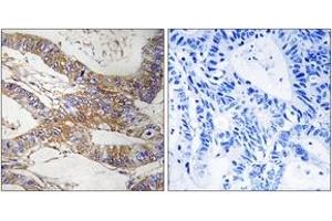 Immunohistochemistry analysis of paraffin-embedded human colon carcinoma tissue, using SERPINB9 Antibody.