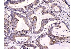 IHC testing of FFPE human intestinal cancer tissue with Calpastatin antibody at 1ug/ml. (Calpastatin 抗体  (AA 275-310))