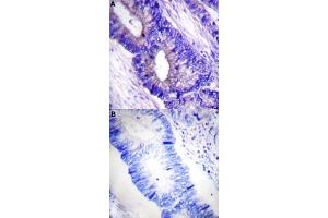 Immunohistochemical staining (Formalin-fixed paraffin-embedded sections) of human colon cancer tissue with PRKACA/PRKACB (phospho T197) polyclonal antibody  without blocking peptide (A) or preincubated with blocking peptide (B) under 1:50-1:100 dilution.