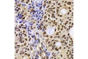Immunohistochemistry of paraffin-embedded human oophoroma using HIRIP3 antibody (ABIN5974221) at dilution of 1/100 (40x lens). (HIRIP3 抗体)