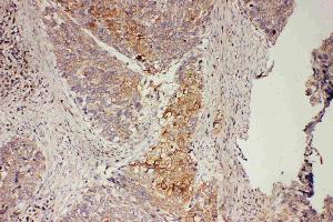 Anti-GRB7 antibody, IHC(P): Human Oesophagus Squama Cancer Tissue