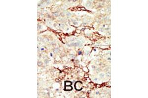 Formalin-fixed and paraffin-embedded human cancer tissue reacted with FGFR3 polyclonal antibody  , which was peroxidase-conjugated to the secondary antibody, followed by DAB staining. (FGFR3 抗体  (C-Term))