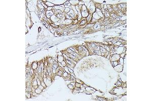 Immunohistochemistry of paraffin-embedded Human pancreatic ductal carcinoma using β-Catenin antibody (ABIN7266137) at dilution of 1:100 (40x lens). (CTNNB1 抗体)