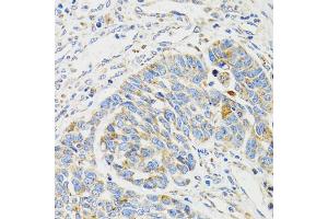 Immunohistochemistry of paraffin-embedded human esophageal cancer using SH2B1 Antibody (ABIN5973245) at dilution of 1/100 (40x lens). (SH2B1 抗体)