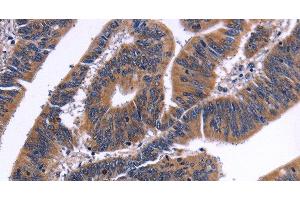 Immunohistochemistry of paraffin-embedded Human colon cancer tissue using NFATC3 Polyclonal Antibody at dilution 1:50 (NFATC3 抗体)