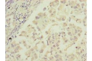Immunohistochemistry of paraffin-embedded human lung cancer using ABIN7172905 at dilution of 1:100 (MTIF3 抗体  (AA 1-278))
