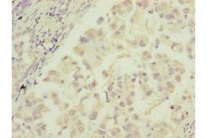 Immunohistochemistry of paraffin-embedded human lung cancer using ABIN7172905 at dilution of 1:100