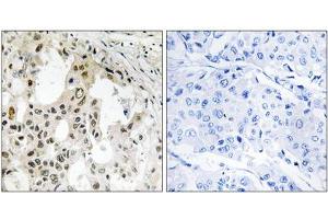 Immunohistochemistry analysis of paraffin-embedded human breast carcinoma tissue using EIF3D antibody. (EIF3D 抗体  (Internal Region))