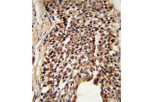 Formalin-fixed and paraffin-embedded human prostate carcinoma reacted with TPI1 Antibody (N-term), which was peroxidase-conjugated to the secondary antibody, followed by DAB staining. (TPI1 抗体  (N-Term))