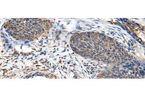 Immunohistochemistry of paraffin-embedded Human cervical cancer tissue using BRI3BP Polyclonal Antibody at dilution of 1:35(x200) (BRI3BP 抗体)