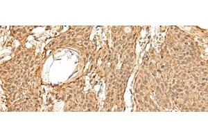 Immunohistochemistry of paraffin-embedded Human esophagus cancer tissue using TIPRL Polyclonal Antibody at dilution of 1:60(x200) (TIPRL 抗体)