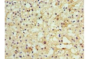 Immunohistochemistry of paraffin-embedded human liver cancer using ABIN7160457 at dilution of 1:100 (MOG 抗体  (AA 30-154))