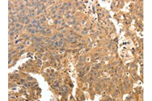 The image on the left is immunohistochemistry of paraffin-embedded Human ovarian cancer tissue using ABIN7130780(PTPRE Antibody) at dilution 1/10, on the right is treated with fusion protein. (PTPRE 抗体)