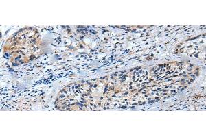 Immunohistochemistry of paraffin-embedded Human cervical cancer tissue using LILRB5 Polyclonal Antibody at dilution of 1:25(x200) (LILRB5 抗体)