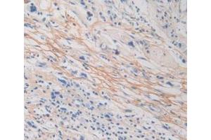 IHC-P analysis of Human Stomach Cancer Tissue, with DAB staining. (Periostin 抗体  (AA 97-230))