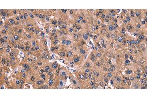Immunohistochemistry of paraffin-embedded Human liver cancer tissue using ADM2 Polyclonal Antibody at dilution 1:40 (Adrenomedullin 2 抗体)