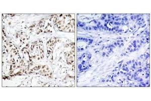 Immunohistochemical analysis of paraffin-embedded human breast carcinoma tissue using SAPK/JNK (phospho-Thr183) antibody (E011249). (SAPK, JNK (pThr183) 抗体)
