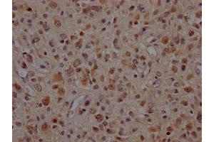 IHC image of ABIN7127867 diluted at 1:100 and staining in paraffin-embedded human glioma cancer performed on a Leica BondTM system. (Recombinant VCP 抗体)