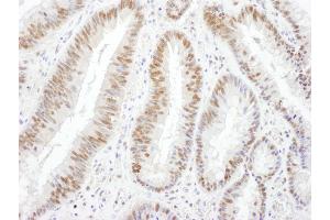 Immunohistochemistry (IHC) image for anti-SWI/SNF Related, Matrix Associated, Actin Dependent Regulator of Chromatin, Subfamily A, Member 4 (SMARCA4) (AA 50-100) antibody (ABIN7454978)