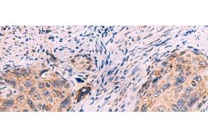 Immunohistochemistry of paraffin-embedded Human cervical cancer tissue using KCNN1 Polyclonal Antibody at dilution of 1:55(x200) (KCNN1 抗体)