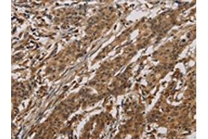 The image on the left is immunohistochemistry of paraffin-embedded Human gastric cancer tissue using ABIN7190293(CLEC2A Antibody) at dilution 1/20, on the right is treated with synthetic peptide. (CLEC2A 抗体)