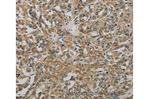 Immunohistochemistry of Human esophagus cancer using E2F6 Polyclonal Antibody at dilution of 1:60