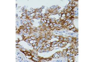 Immunohistochemistry of paraffin-embedded human lung cancer using FCGR1B antibody (ABIN7267161) at dilution of 1:100 (40x lens). (FCGR1B 抗体)