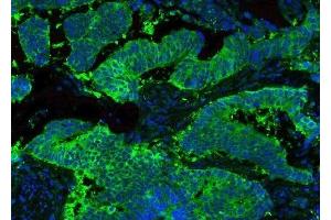 IF analysis of HSP90AB1 using anti-HSP90AB1 antibody (ABIN3042462) HSP90AB1 was detected in paraffin-embedded section of human lung cancer tissues.