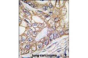 Formalin-fixed and paraffin-embedded human lung carcinoma tissue reacted with Ihh Antibody (N-term) (ABIN389152 and ABIN2850533) , which was peroxidase-conjugated to the secondary antibody, followed by DAB staining. (Indian Hedgehog 抗体  (N-Term))