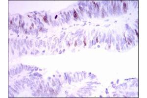 Immunohistochemical analysis of paraffin-embedded rectum cancer tissues using INCENP mouse mAb with DAB staining. (INCENP 抗体  (AA 369-583))