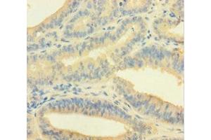 Immunohistochemistry of paraffin-embedded human endometrial cancer using ABIN7148691 at dilution of 1:100 (Crossover junction endonuclease EME1 (EME1) (AA 1-583) 抗体)