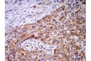 Immunohistochemical analysis of paraffin-embedded cervical cancer tissues using PGRMC1 mouse mAb with DAB staining. (PGRMC1 抗体  (AA 1-195))