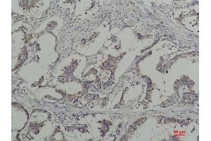 Immunohistochemical analysis of paraffin-embedded Human Breast Caricnoma using Phosphotyrosine Mouse mAb diluted at 1:200. (Phosphotyrosine 抗体)