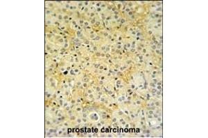 DAZ Antibody (C-term) (ABIN653931 and ABIN2843163) IHC analysis in formalin fixed and paraffin embedded prostate carcinoma followed by peroxidase conjugation of the secondary antibody and DAB staining. (DAZAP2 抗体  (C-Term))