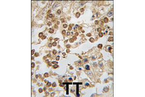 Formalin-fixed and paraffin-embedded human testis tissue reacted with DPPA4 polyclonal antibody  , which was peroxidase-conjugated to the secondary antibody, followed by DAB staining. (DPPA4 抗体  (N-Term))