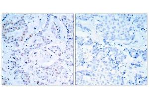 Immunohistochemical analysis of paraffin-embedded human breast carcinoma tissue using Estrogen Receptor-α (Ab-104) antibody (E021065). (Estrogen Receptor alpha 抗体)