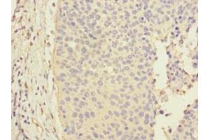 Immunohistochemistry of paraffin-embedded human cervical cancer using ABIN7146495 at dilution of 1:100 (CALML3 抗体  (AA 1-149))