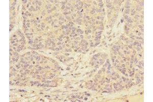 Immunohistochemistry of paraffin-embedded human ovarian cancer using ABIN7173562 at dilution of 1:100 (Tropomyosin 4 抗体  (AA 1-248))