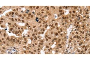 Immunohistochemistry of paraffin-embedded Human breast cancer using SMARCB1 Polyclonal Antibody at dilution of 1:30 (SMARCB1 抗体)